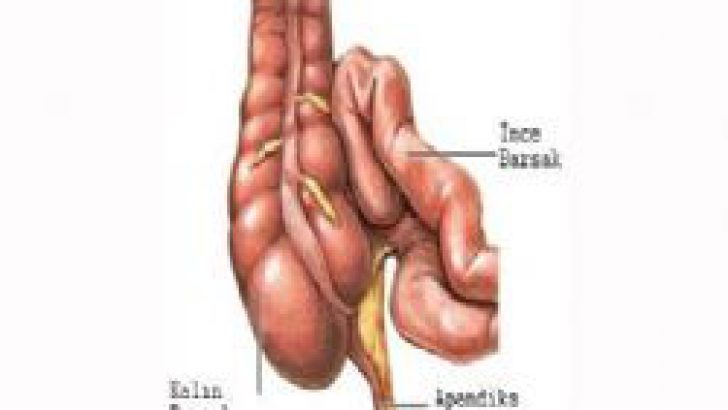 Apandisit Nedir, Belirtileri, Tedavisi Nelerdir?